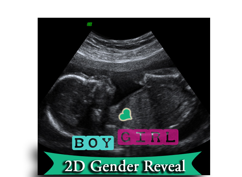 Scan gender reveal